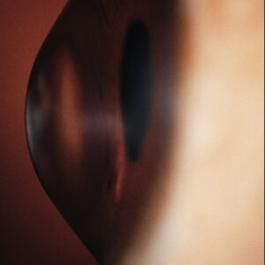 keratoconus